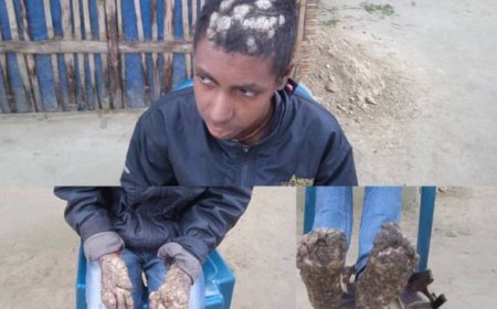 Bangladeshi Tree-Men and Woman Facing Multiple Challenges